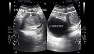 Ultrasound Video showing Large Lt. Ovarian Cyst and Endometrial hyperplasia.