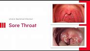 Sore Throat: Viral or Bacterial Infection