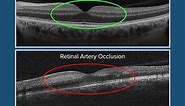 Normal vs. Retinal Artery Occlusion