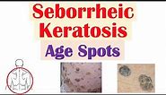 Seborrheic Keratosis (“Age Spots”) | Risk Factors, Causes, Skin Lesions, Diagnosis, Treatment