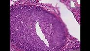 Squamous Metaplasia of Cervix & Carcinoma in Situ Histopathology- Madeformedical.com