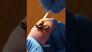 Treatment Options for Genital Warts l Dr. Ahmad Clinic