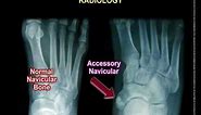 Accessory Navicular Bone - Everything You Need To Know - Dr. Nabil Ebraheim
