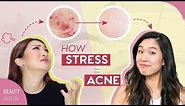 5 Signs + 5 Easy Cures to Prevent ACNE and STRESSED Skin