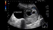 Ultrasound Video showing an early pregnancy with an ovarian cyst.