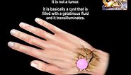 Ganglion Cyst Of The Wrist - Everything You Need To Know - Dr. Nabil Ebraheim
