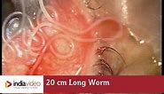 20 cm Long Worm In The Human Eye, First Ever Recorded On Video | India Video