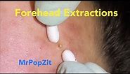 Forehead Acne Extractions. Blackheads, whiteheads, milia popped. Pores cleared, pore dirt. Mini pops