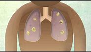 How The Body Reacts To Tuberculosis