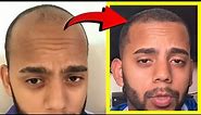 Crazy Minoxidil 5% Hair Growth in 2.5 Months Fails after 2.5 YEARS!? Here's WHY!