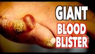GIANT BLOOD BLISTER + Cutting Off a Dead Wart | Dr. Paul