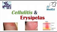 Cellulitis vs Erysipelas | Bacterial Causes, Risk Factors, Signs and Symptoms, Treatment