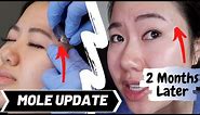 Facial Mole Removal Healing Process + 2 Month Update // Regrets? | Mole Shaving Experience