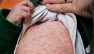 Viral Rash On Child: Types, Causes, Treatment & Prevention