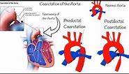 Coarctation of the Aorta - Symptoms, Diagnosis and Treatment
