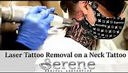Watch This Laser Tattoo Removal on a Black Neck Tattoo
