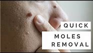 2 quick Natural Home Remedies for Moles removal that really work!!
