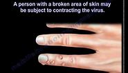 Skin Warts , Hand warts - Everything You Need To Know - Dr. Nabil Ebraheim