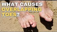 Overlapping Toes: Causes and Solutions