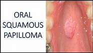 Oral Squamous Papilloma - Benign Tumour of Epithelial Tissue I Dental Guide I Dr. Bimal Chand I