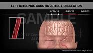 Carotid Artery Dissection Animated Timeline