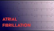 Atrial Fibrillation (Afib) - EKG (ECG) Interpretation
