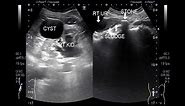 Ultrasound Video showing a simple renal cyst and stone & sludge in ureter.