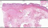 Gastrointestinal Stromal Tumor (GIST) - Histopathology