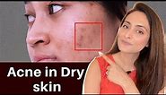 Acne in Dry Skin | what to use | serums, creams | Dermatologist recommends
