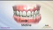 Orthodontic Treatment for Narrow Upper Jaw with Functional Shift - Expander or Spacer