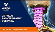 Cervical Radiculopathy Overview