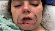 Woman Gets Surgery to Restore Lip Her Ex-Boyfriend Bit Off