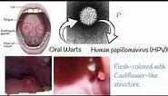 Oral Papilloma - Symptoms, causes, treatment
