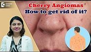 RED DOTS ON SKIN | Cherry Angioma & its Treatment | Red Moles - Dr. Amee Daxini | Doctors' Circle