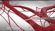 TCAR | TransCarotid Artery Revascularization Procedure Animation | Silk Road Medical | 90sec