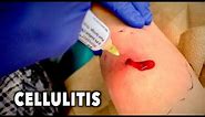 ABSCESS WITH CELLULITIS... (We had to drain it) | Dr. Paul