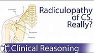 Suprascapular Nerve Entrapment mimicking C5 Radiculopathy