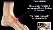 Foot and Ankle ganglion cyst - Everything You Need To Know - Dr. Nabil Ebraheim