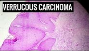 Verrucous Carcinoma - How To Diagnose?