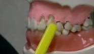 What Causes Gum Recession and How To Treat It