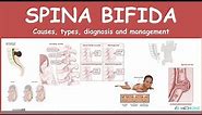 Spina bifida: Types (myelomeningocele, meningocele, occulta) - causes, symptoms, diagnosis treatment