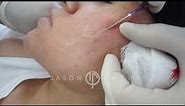 Subcision for Acne Scars | Acne Scar Treatment | Cheek Acne Scar Removal | Dr. Jason Emer