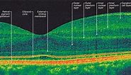What Is Optical Coherence Tomography?
