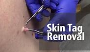 Skin Tag Removal | Dr. Derm
