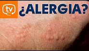 Cómo identificar una reacción alérgica