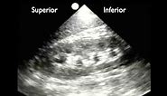 How To: Renal Ultrasound - Hydronephrosis Case Study Video