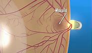 What Is a Macular Hole?