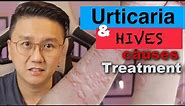 URTICARIA & HIVES - Causes and Treatment of Itchy Skin Rash