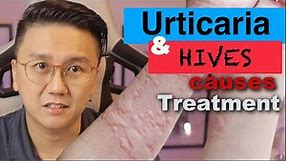 URTICARIA & HIVES - Causes and Treatment of Itchy Skin Rash