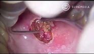 Removal of Oral Squamous Papilloma on soft palate with Diode Laser and Operative Microscope.